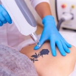 Tattoo Removal Dubai