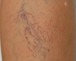 VenoCare Clinic - Treatment of Spider Veins