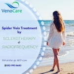 Varicose Veins Treatments at VenoCare