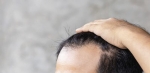 IS A HAIR TRANSPLANT PERMANENT?