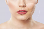 Best Acne Scars Treatment in Kashipur | Dr. Sarna Clinic