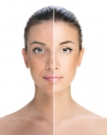 Spectra Laser Carbon Peel