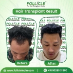 Best Hair Transplant Clinic