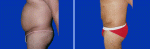 Megaliposuction Surgery in India