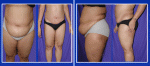 Tummy Tuck in India