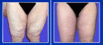 Thigh Lift (Thighplasty) Surgery India