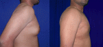 Gynecomastia Surgery India