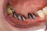 Best All-On-4 Treatment In India and All-On-4 Dental Implants