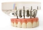 Dental Implants, Tooth Implants, Full Mouth Dental Implants Clinic in Delhi, India
