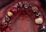 All-on-4 Dental Implant India, best All-on-4 clinic India, All-on-4 India