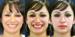 Dimple Creation Surgery,  Dimple Creation Surgery Delhi, India