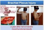 Brachial Plexus Reconstruction, Brachial Plexus Reconstruction in Delhi India