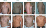 Gender Reassignment Surgery