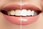 Teeth Whitening Dubai