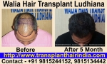 Hair Transplant India Ludhiana Punjab Walia Hospital