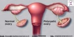 PCOS Treatment in Gurgaon