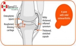 All you need to know about Osteoarthritis Knee