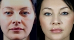 Dermal Fillers