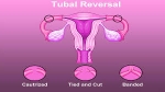 Affordable Tubal Reversal |  MybabyDoc