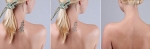 Tattoo Removal Edmonton