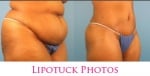 Tummy Tuck Houston