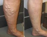 Varicose Veins