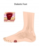 Diabetic Foot and Wound Care Clinic