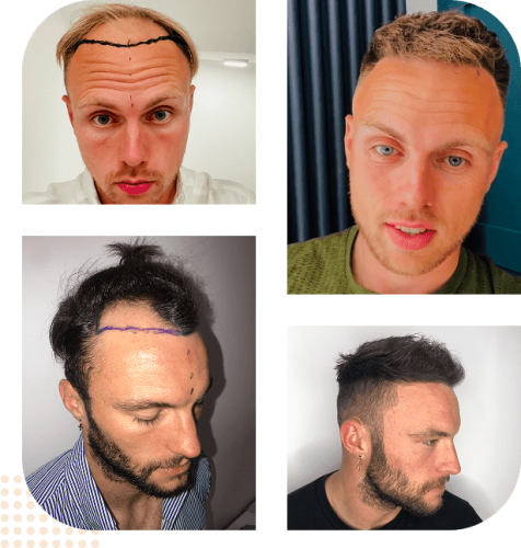 Hair Transplant Harley St London