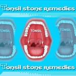 Tonsil Stone Remedies: Treat Tonsil Stones with Ca