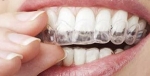 Las Vegas Invisalign