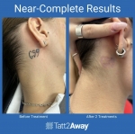 Tatt2Away® Clearwater